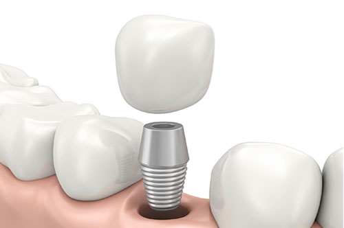 Fall Into a Strong Smile With Dental Implants [SOCIAL]