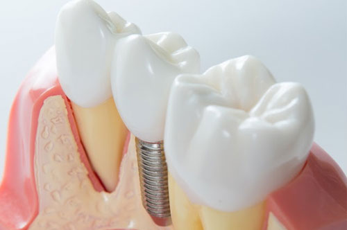 Spring into Your New Smile With Dental Implants [BLOG]