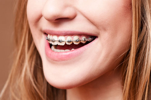 Tips For Taking Care Of Your Braces At Halloween